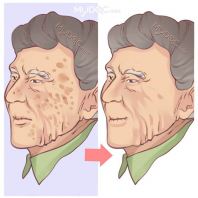 RAWATAN JERAGAT (LIVER SPOTS)