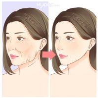 Skin Rejuvenation