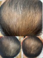 Keputusan Sebelum & Selepas Rawatan Head Spa Premium & Rawatan Kulit Kepala di Seremban