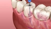 Root Canal Treatment