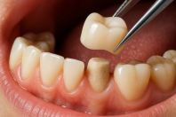 Dental Crown Johor Bahru | Tooth Cap JB Mount Austin & Taman Pelangi