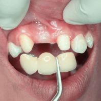 Dental Bridge Johor Bahru | Missing Teeth Replacement JB Mount Austin & Taman Pelangi