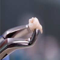 Painless Tooth Extraction Johor Bahru | Gentle Tooth Removal JB Mount Austin & Taman Pelangi