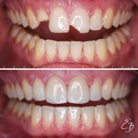 ��ѧ��������Ȼɫ�����޸�������ɽ Johor Bahru Aesthetic Tooth Filling JB��Idea Dental��Mount Austin & Taman Pelangi��