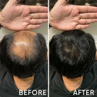 Natural Looking Invisible Hair Wig Before & After | Hair Wigs King Malaysia